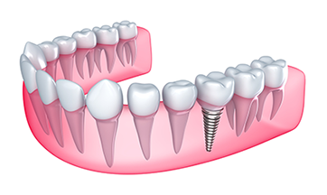 Dental Implants Upper East Side